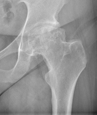 Illustration d’une coxarthrose